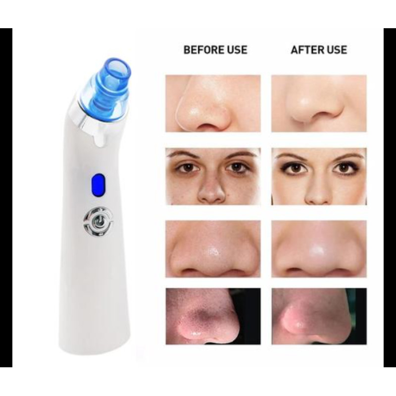 Електричний пристрій для видалення чорних цяток DYM-001 з 5 рівнями всмоктування та 4 насадками (Білий)